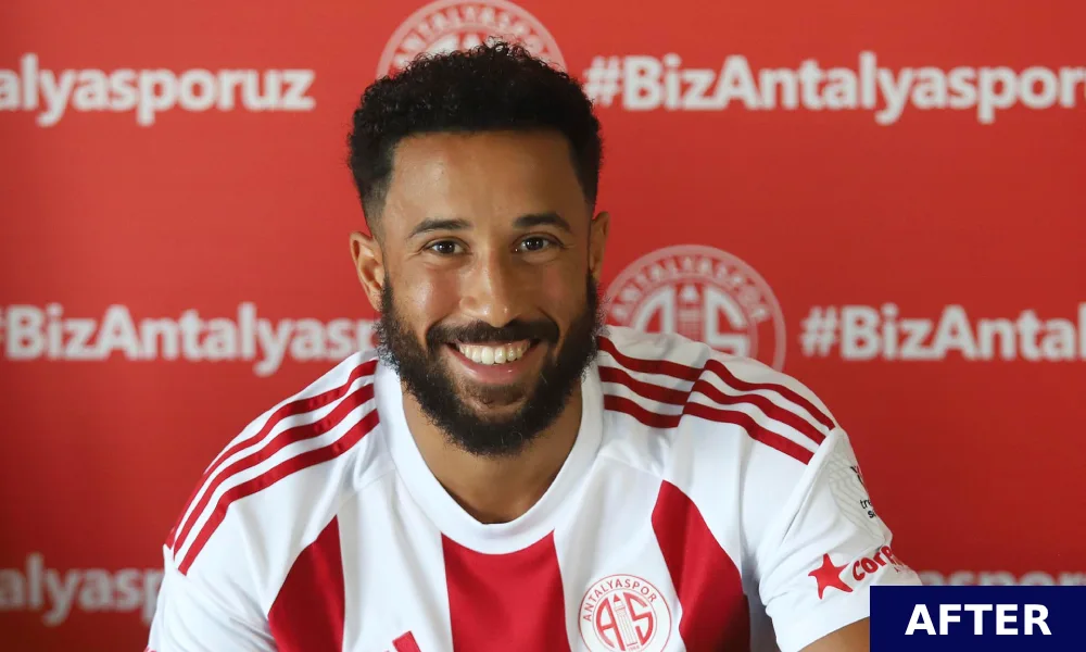 andros townsend after hair transplant 2024