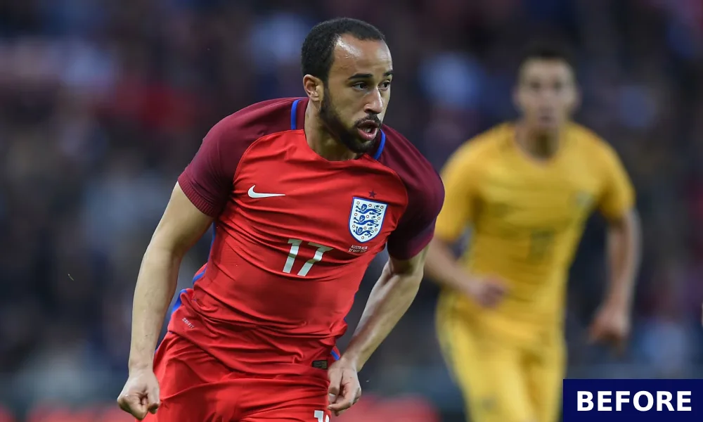 andros townsend before hair transplant 2017