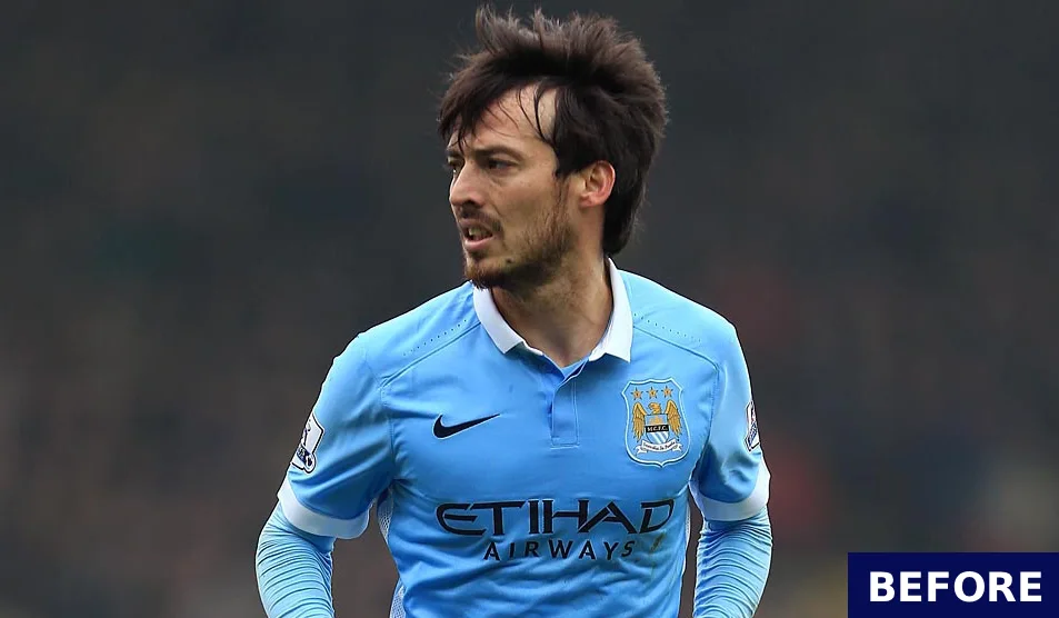 david silva before hair transplant 2016