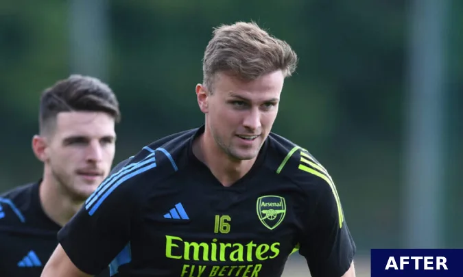 rob holding after hair transplant 2024