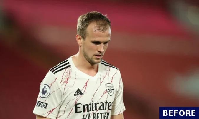 rob holding before hair transplant 2019