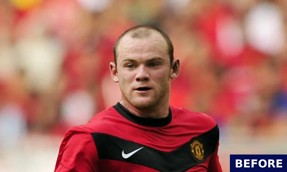 wayne rooney before hair transplant 2011