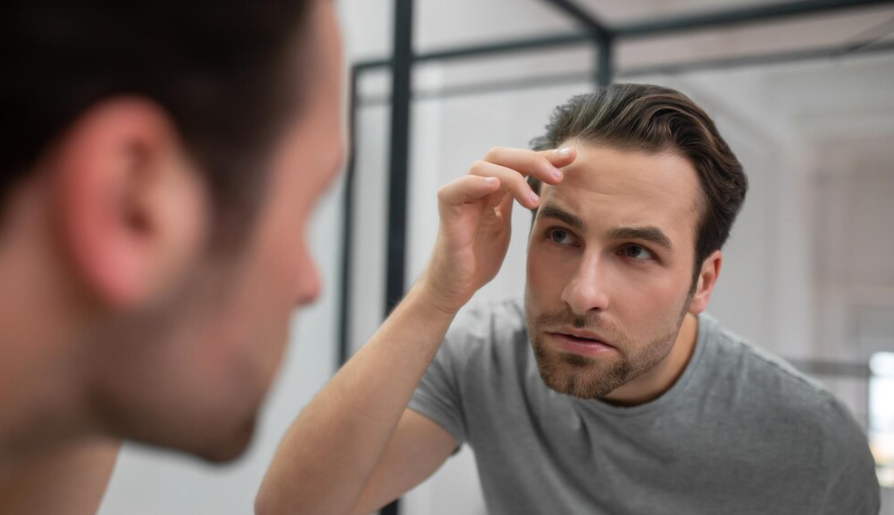 receding hairline transplant