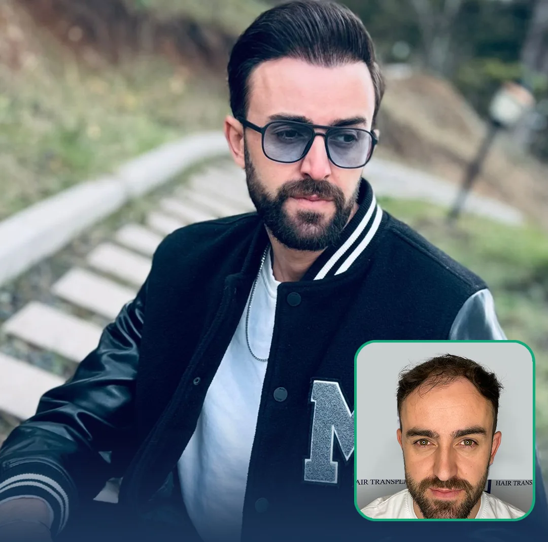 hair restoration result london