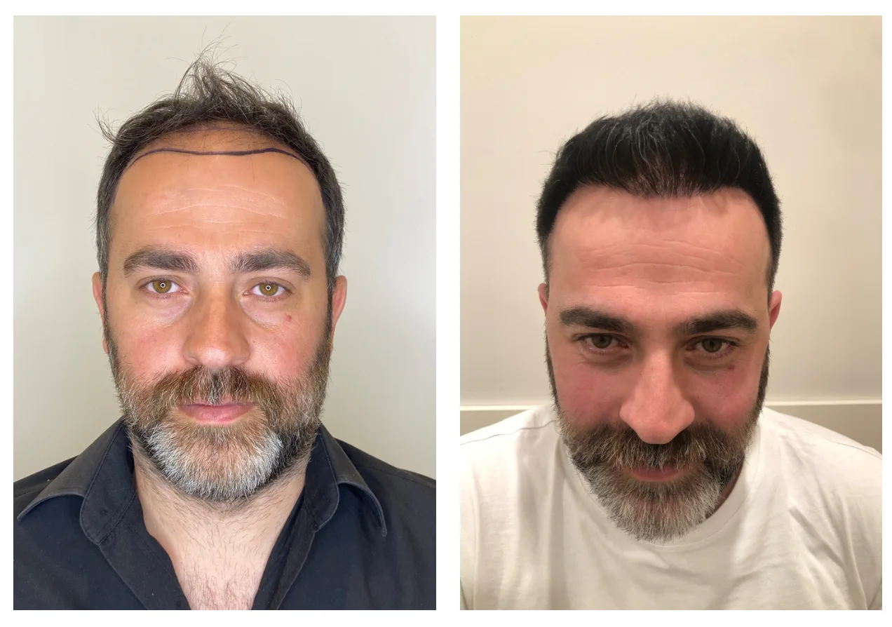 hair transplant 1 year after photo