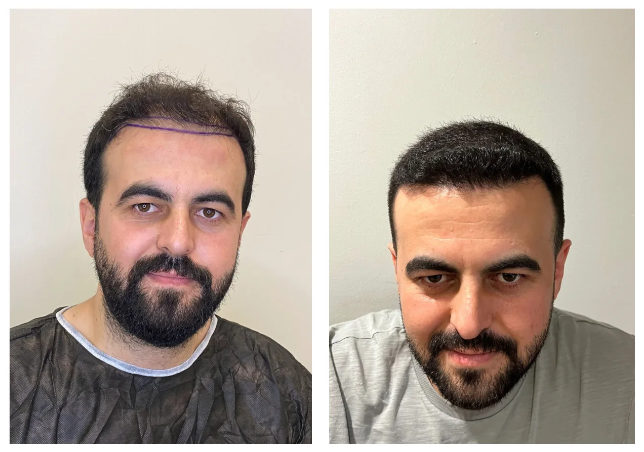 hair transplant 1 year after result