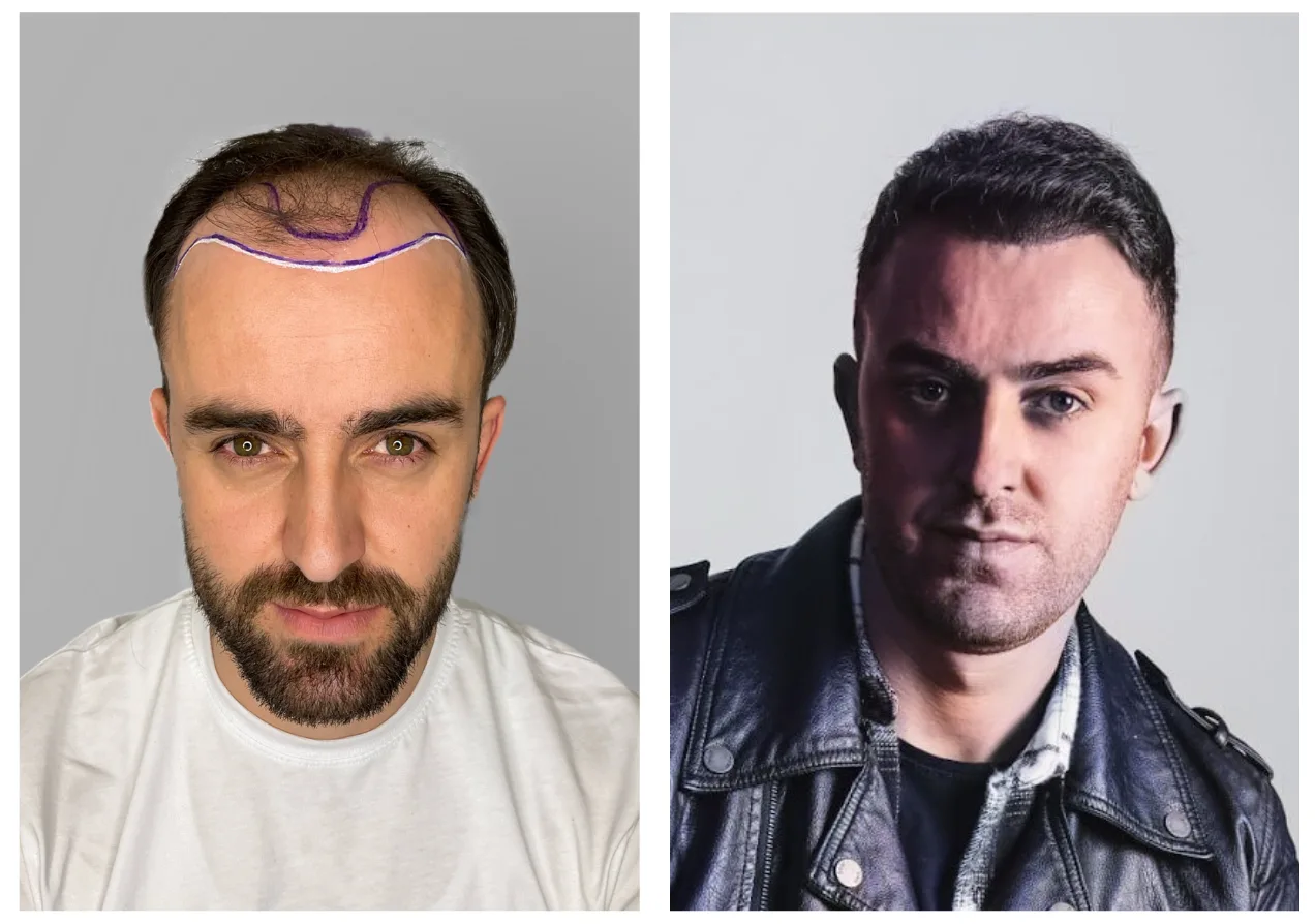 hair transplant before after 1 year young patient