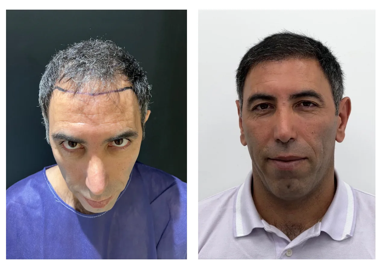 hair transplant before after 12 months
