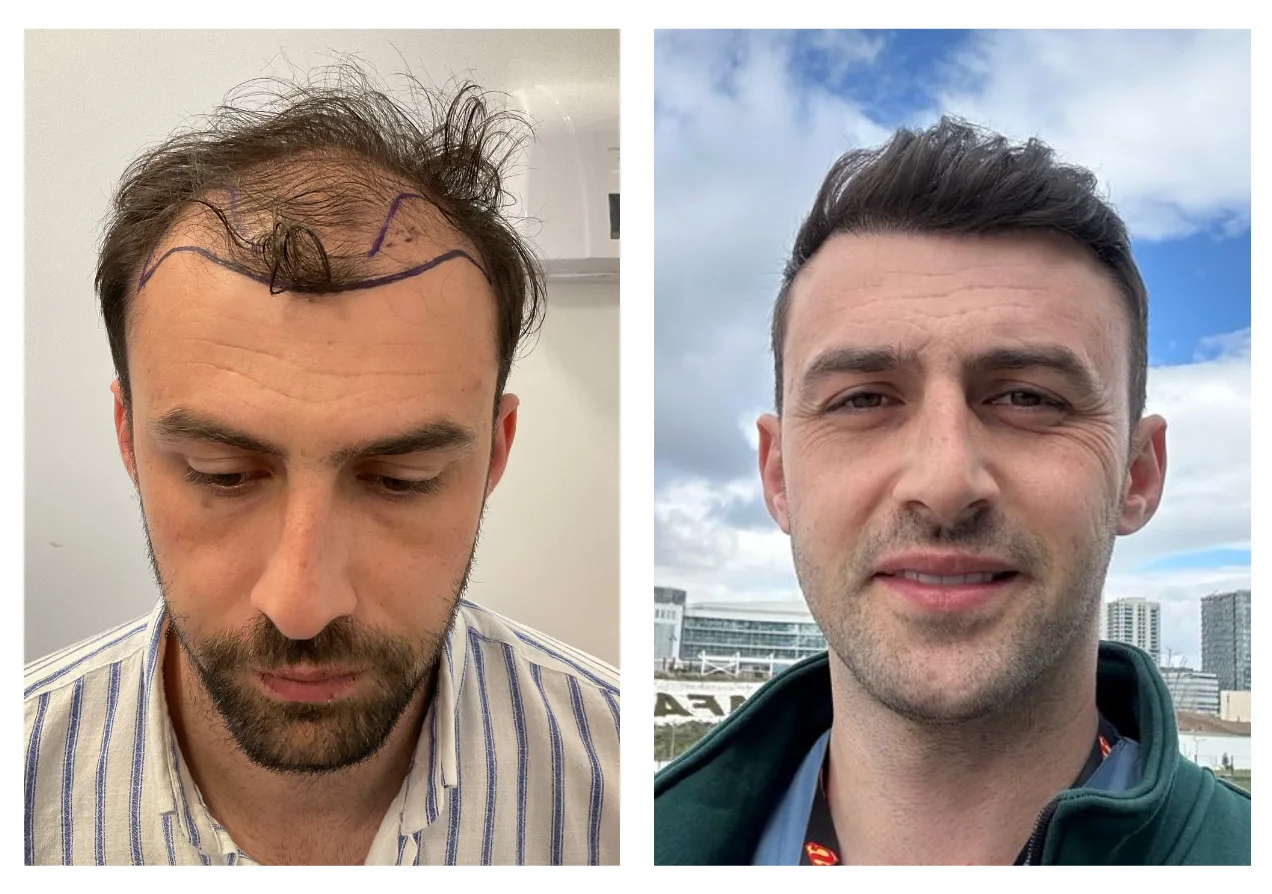hair transplant before after 13 months