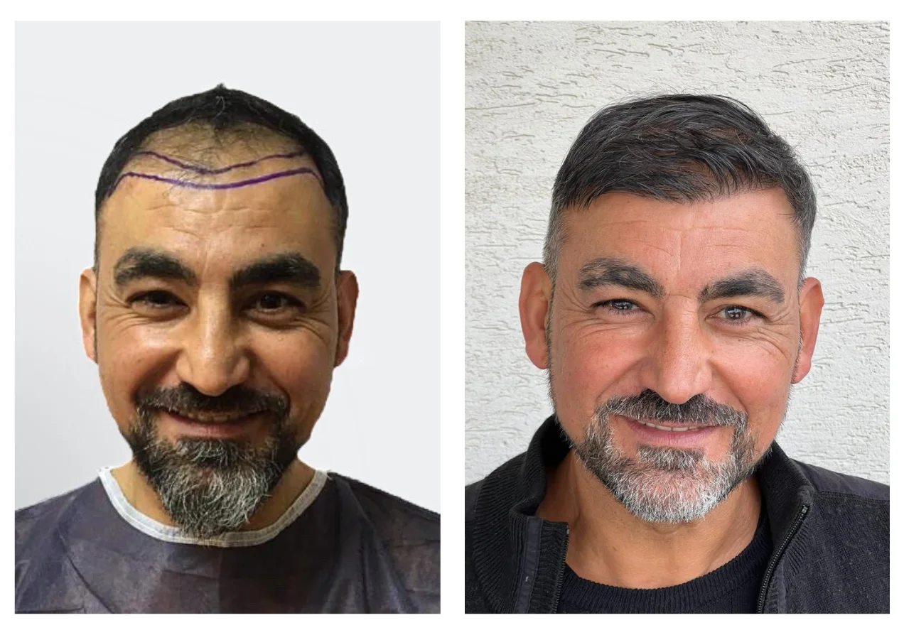 hair transplant before after 40years age