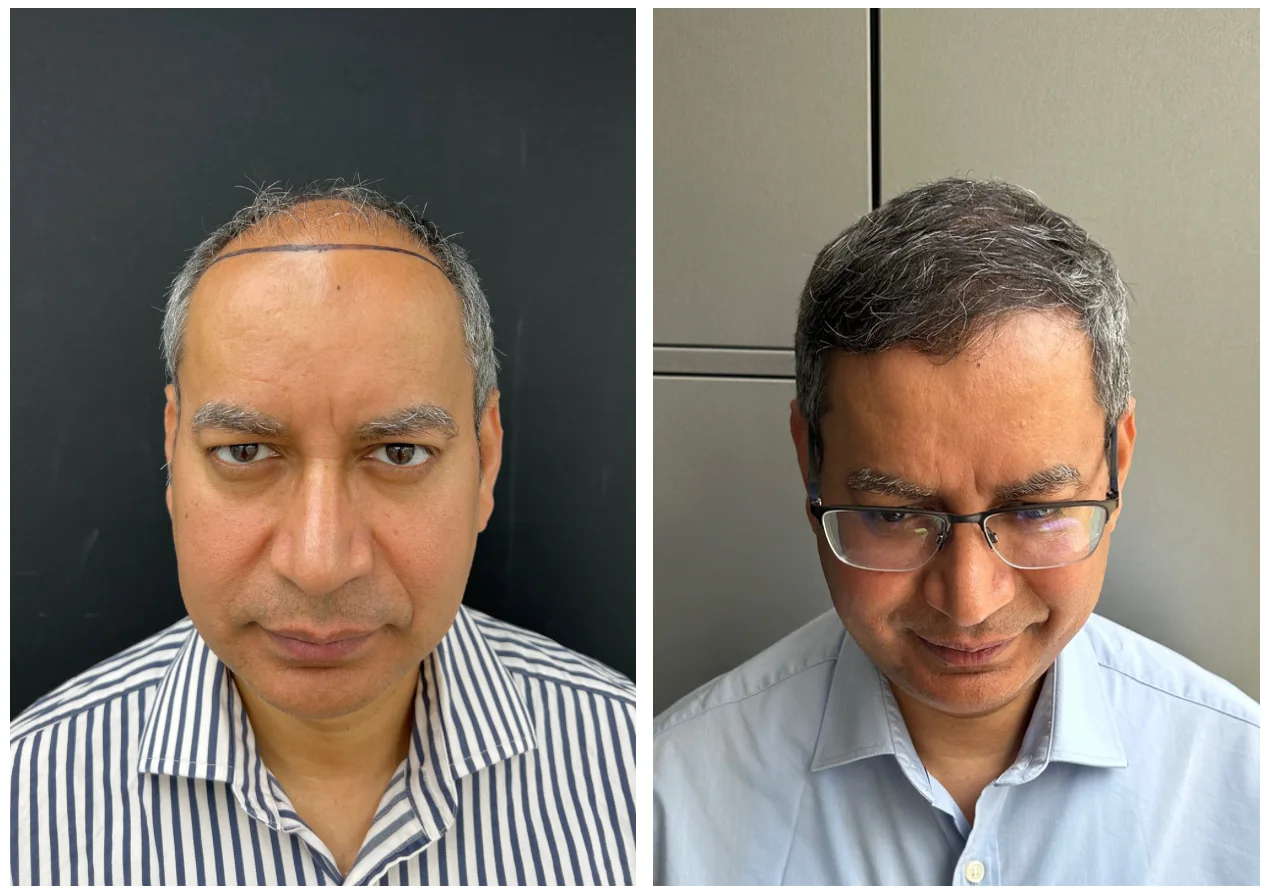 hair transplant before after fks clinic 1