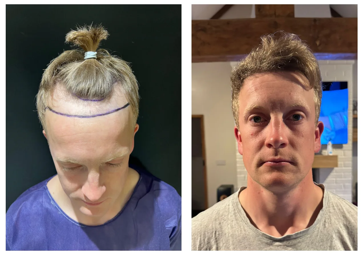 hair transplant before after yellow hair