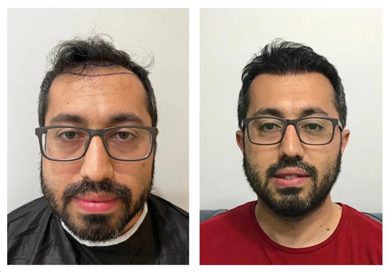 hair transplant before and 1 year after