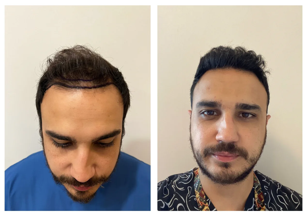 hair transplant before and after 1 year