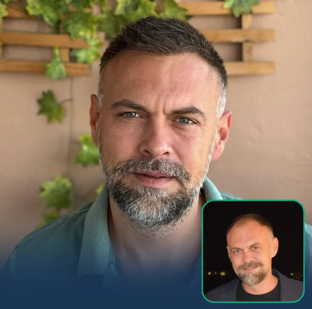hair transplant clinic result
