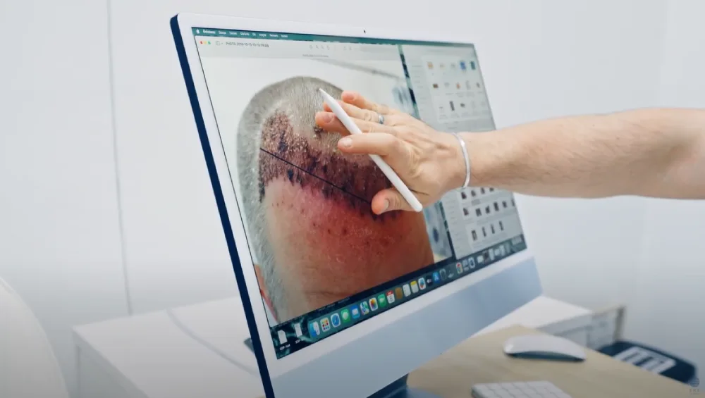 hair transplant patients2