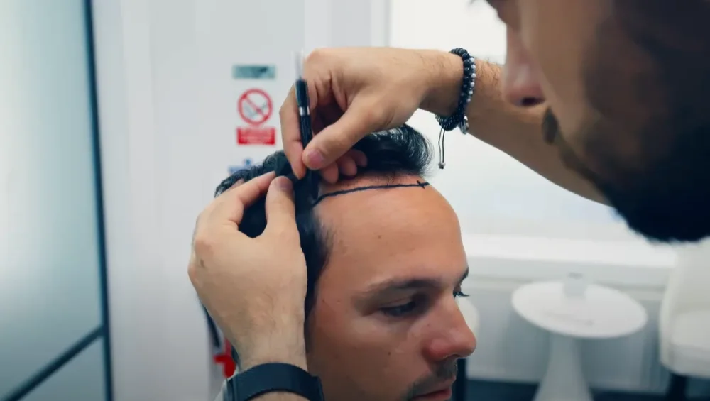 hair transplant patients3