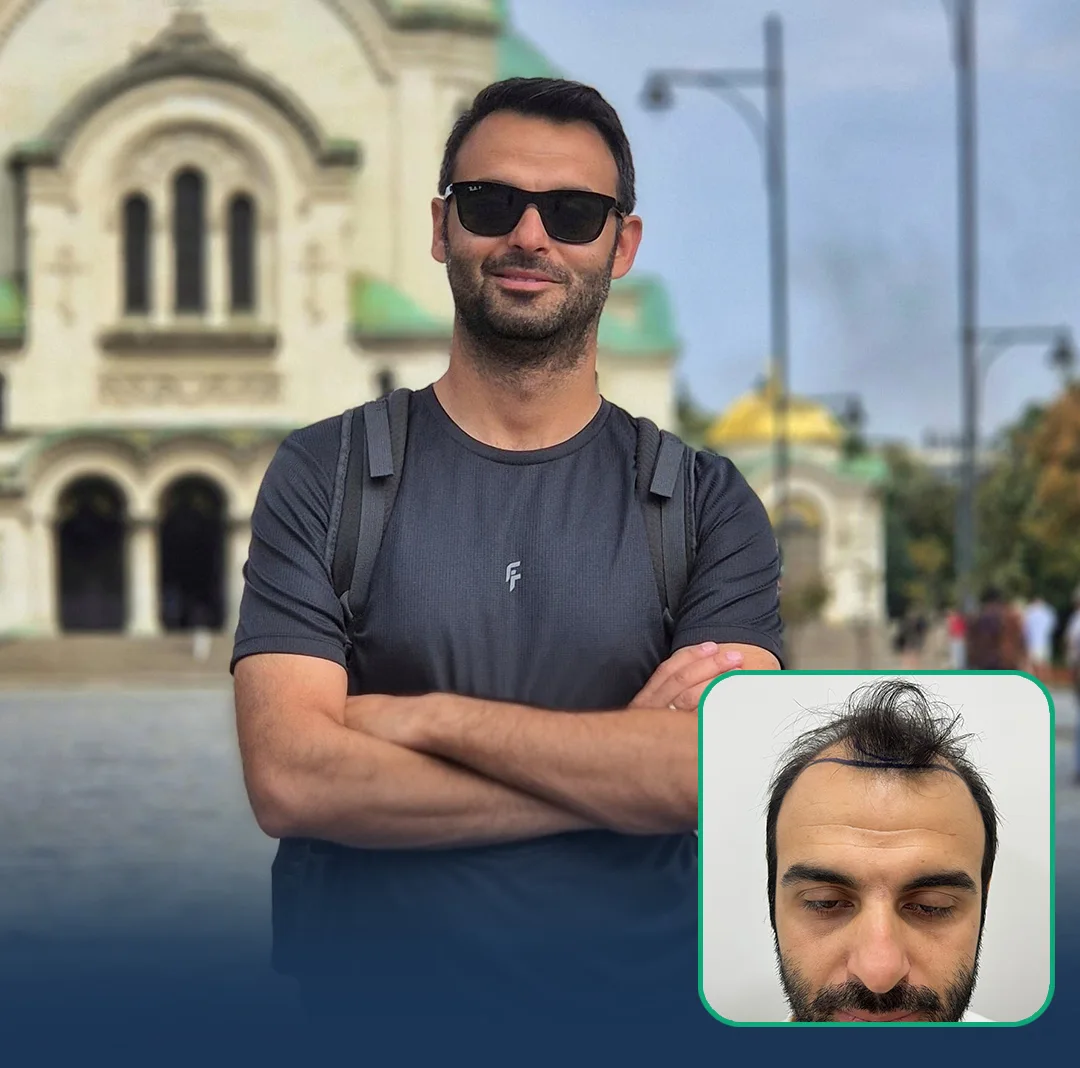 hair transplant result 3