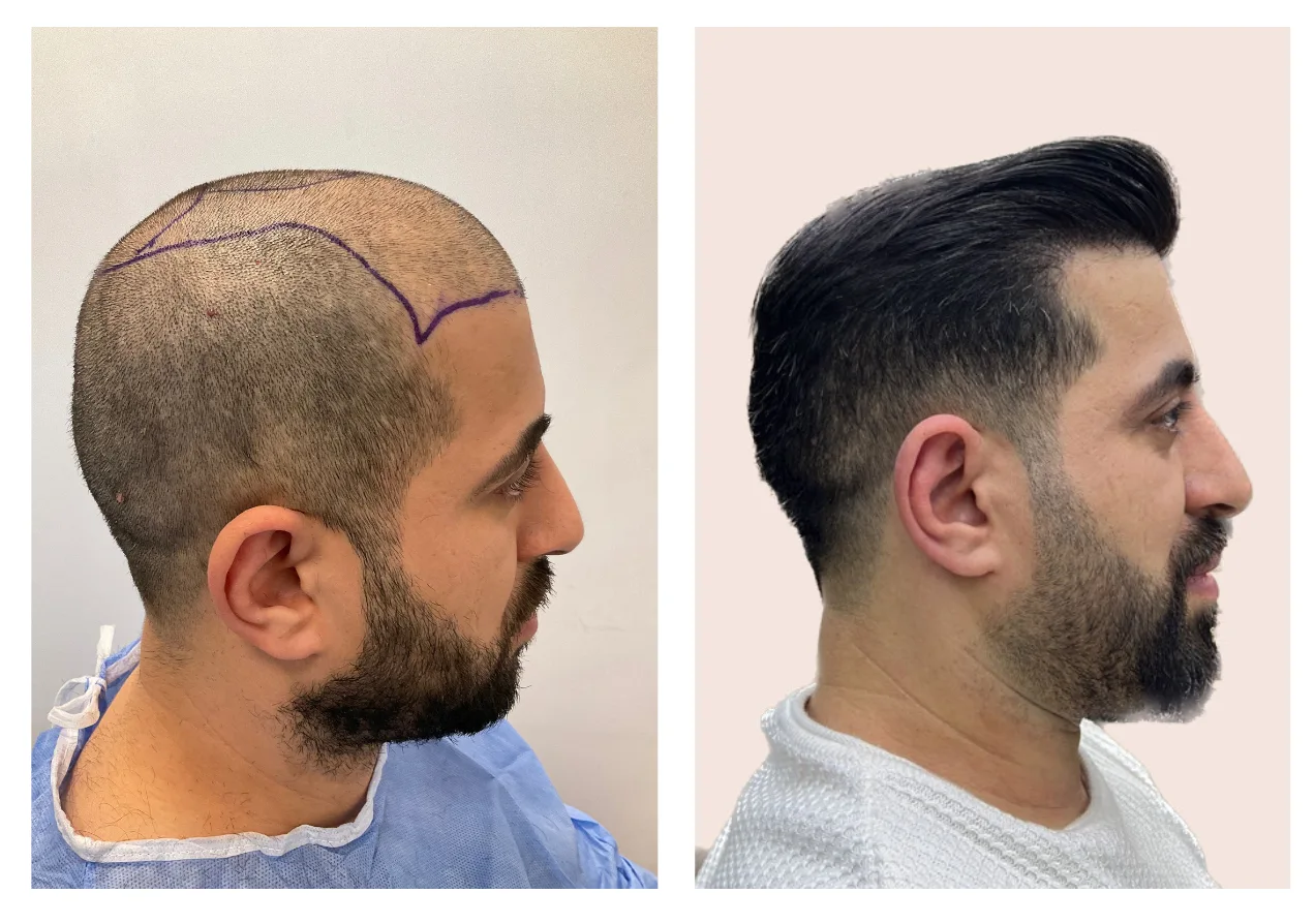 hairline transplant before after