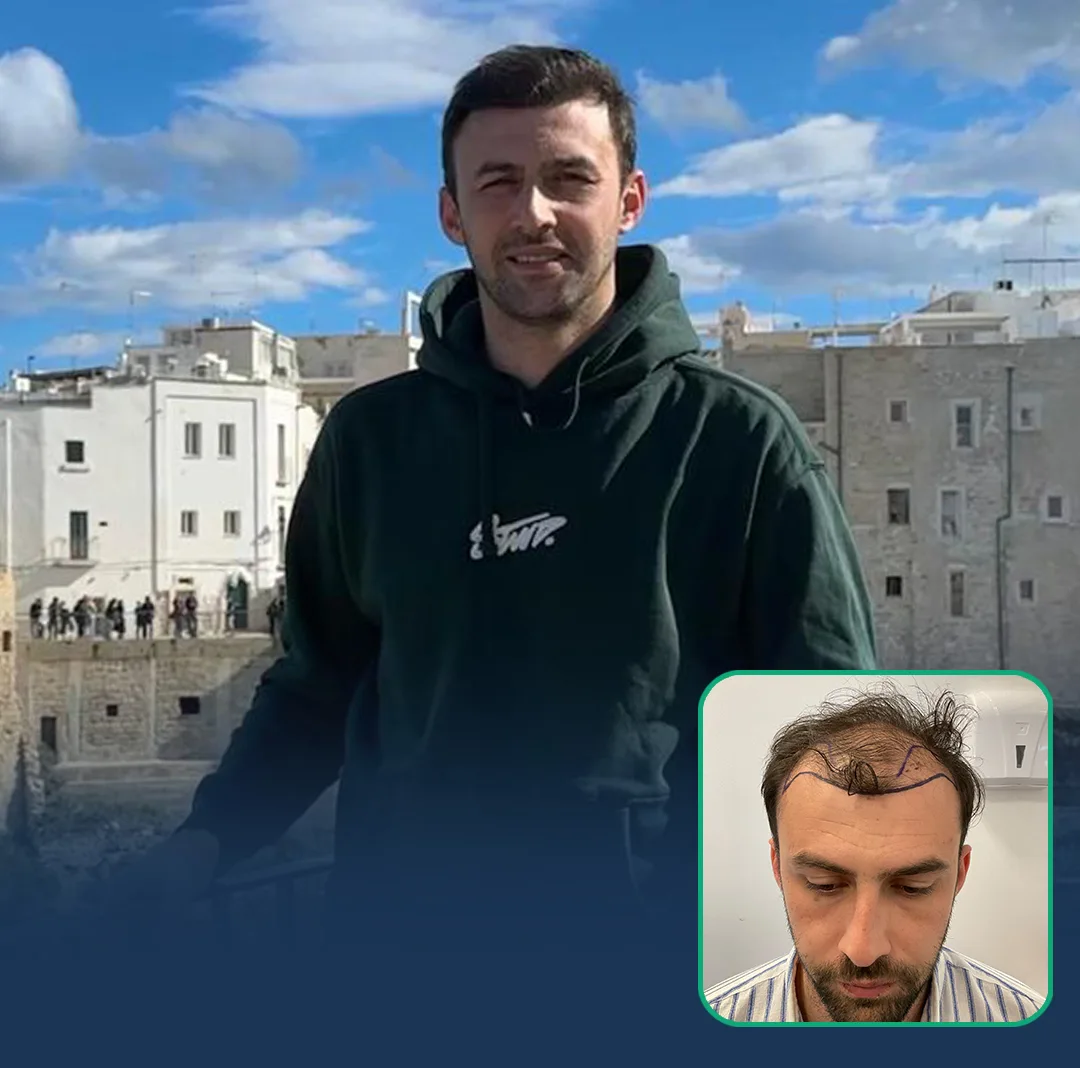 london hair transplant result 1