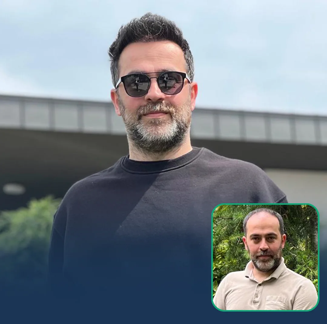 london hair transplant result