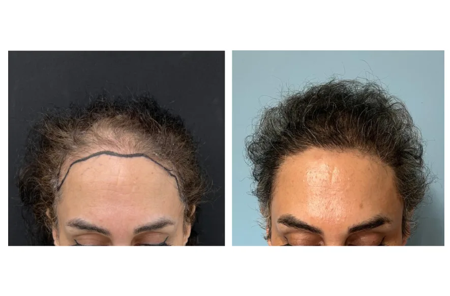 female hair transplant before after 1