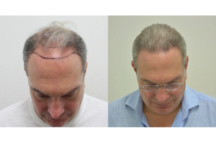 hair transplant london before after 1