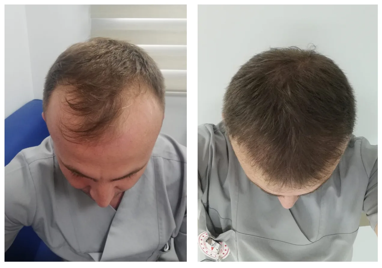 hair transplant uk before after london