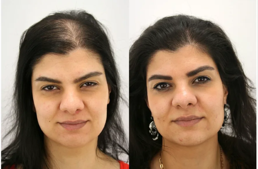 woman hair transplant before after 1