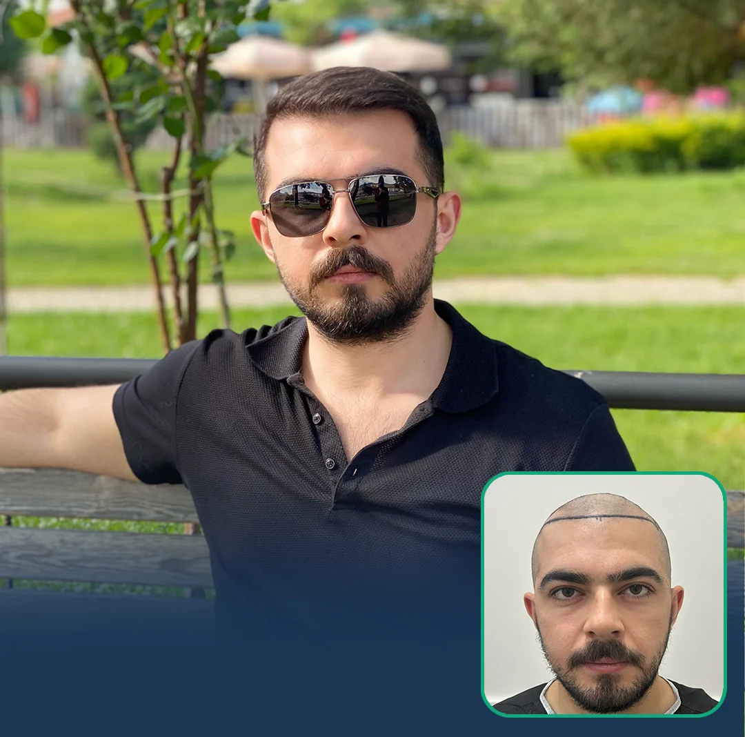 before after hair transplant london