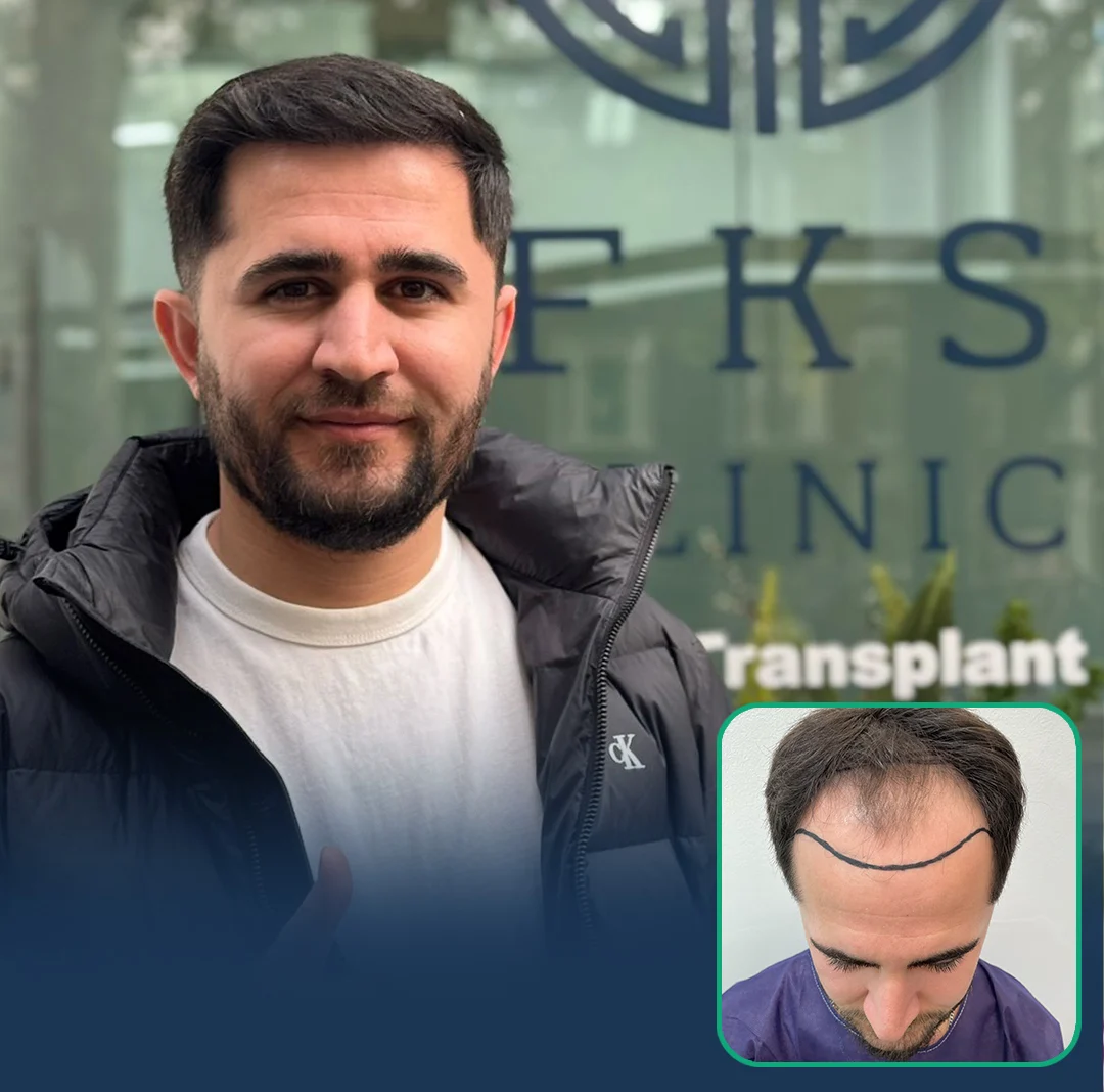 fks hair transplant results united kingdom