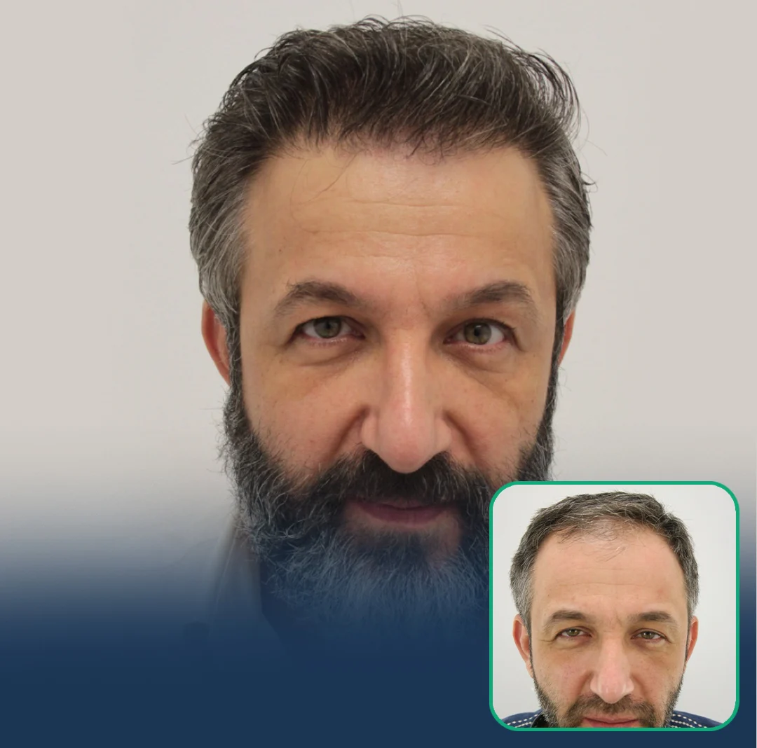 hair clinic transplant results