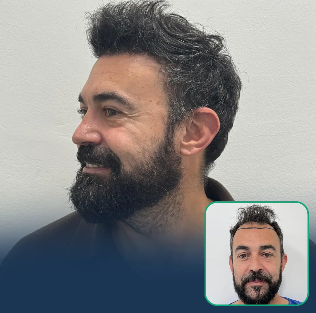 hair transplant before after 2026