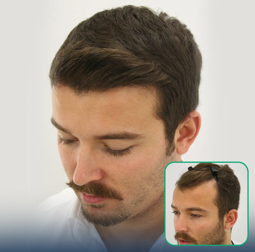 hair transplant results 2026