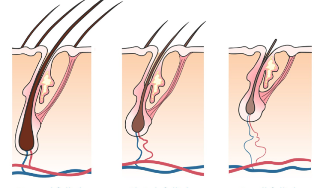 hair-follicle-loss